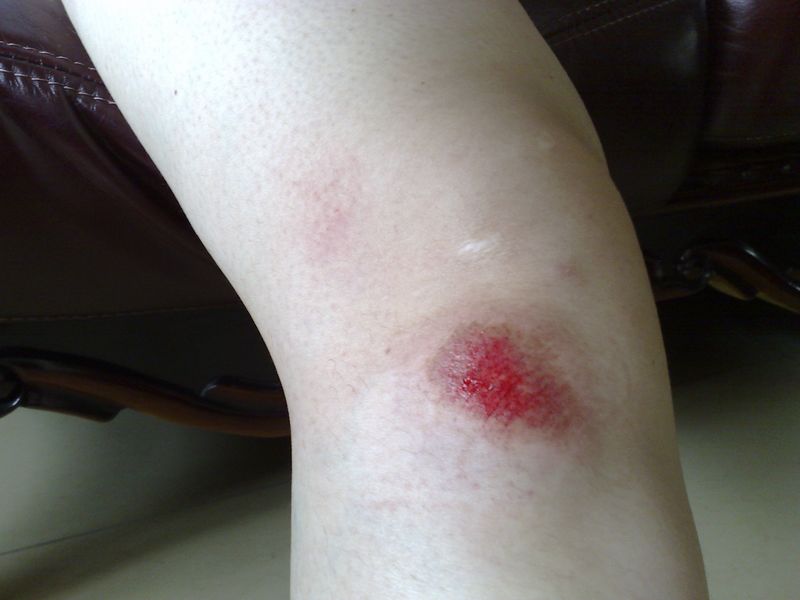 旧痕未消，又添新疤。