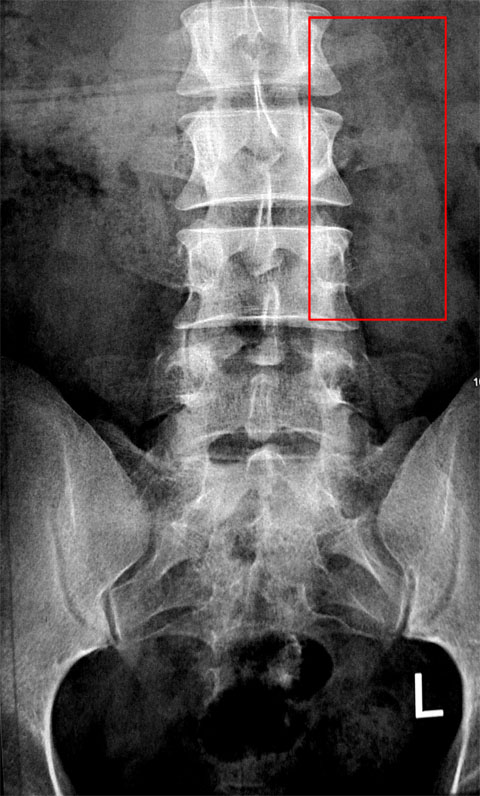 我也顺利加入骨折帮了，哈哈