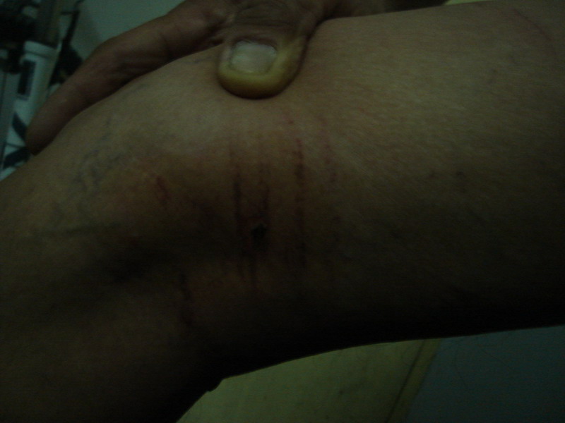 被护膝勒成的伤痕