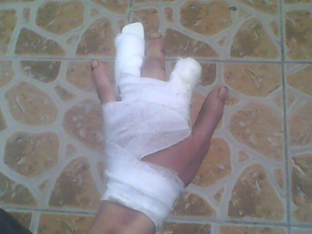 左手食指不是骑车骑得，是03年厂子上班时受的伤，掉了半个