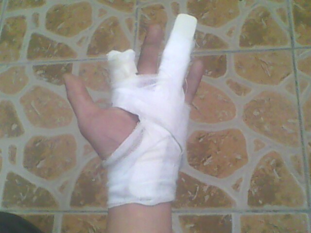 左手食指不是骑车骑得，是03年厂子上班时受的伤，掉了半个